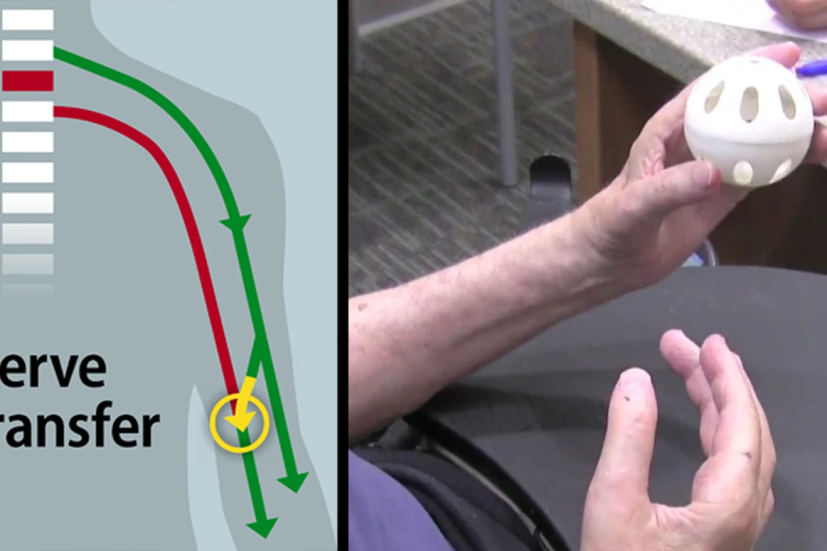 Surgeons have restored some hand function to a quadriplegic patient by rerouting nerves in the patient’s upper arm to bypass the block at their C7 spinal cord injury