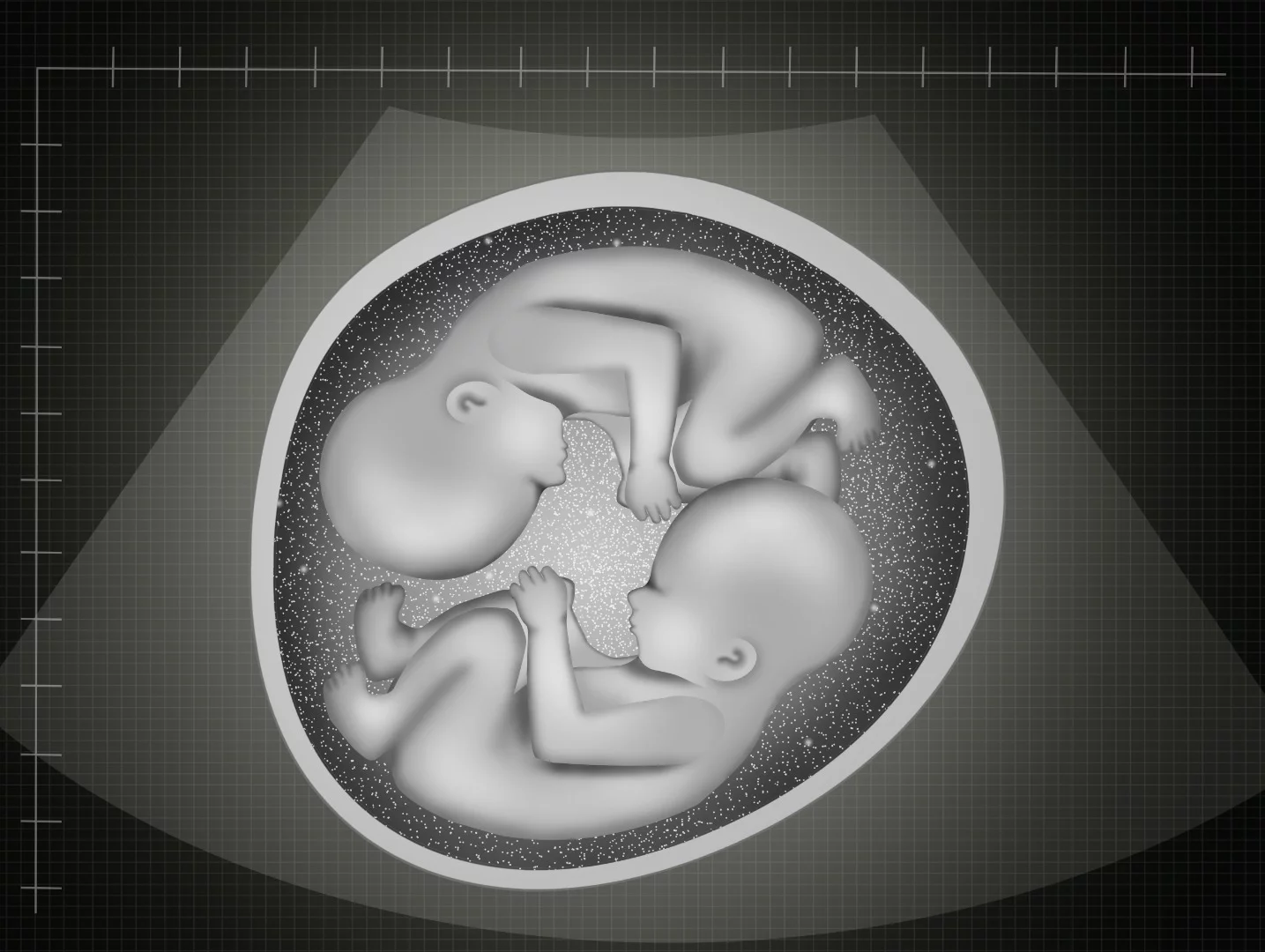 Semi-identical twins born in Australia mark only the second known case in the world