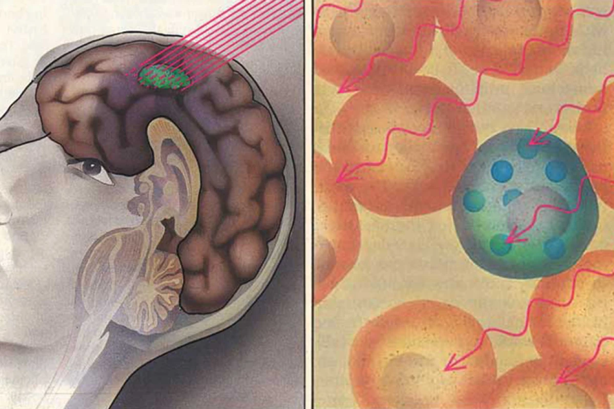 Boron neutron capture therapy can kill tumors without harming healthy neighboring tissue