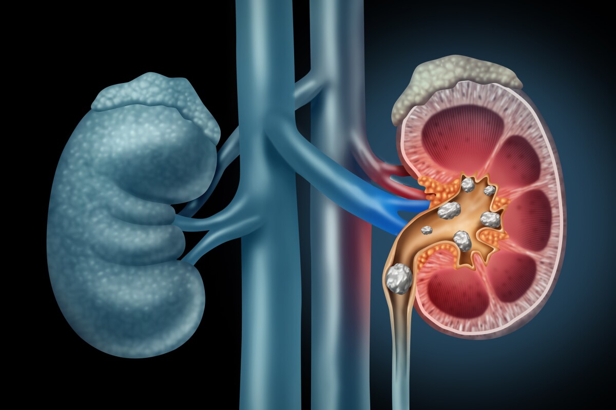 MIT researchers have found a new combination of muscle relaxing drugs that could help patients pass kidney stones less painfully