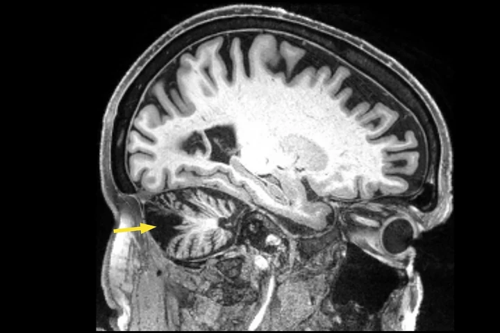Using magnetic stimulation on the brain of a man who had a stroke 12 years ago improved his movement and coordination, a case study has shown