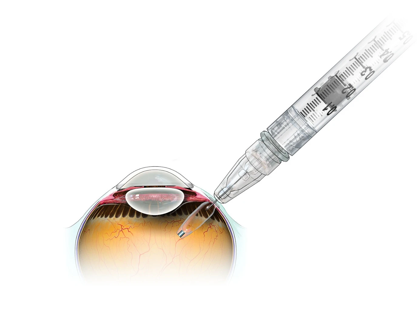 The Port Delivery System incorporates an implanted drug reservoir, which is externally refilled