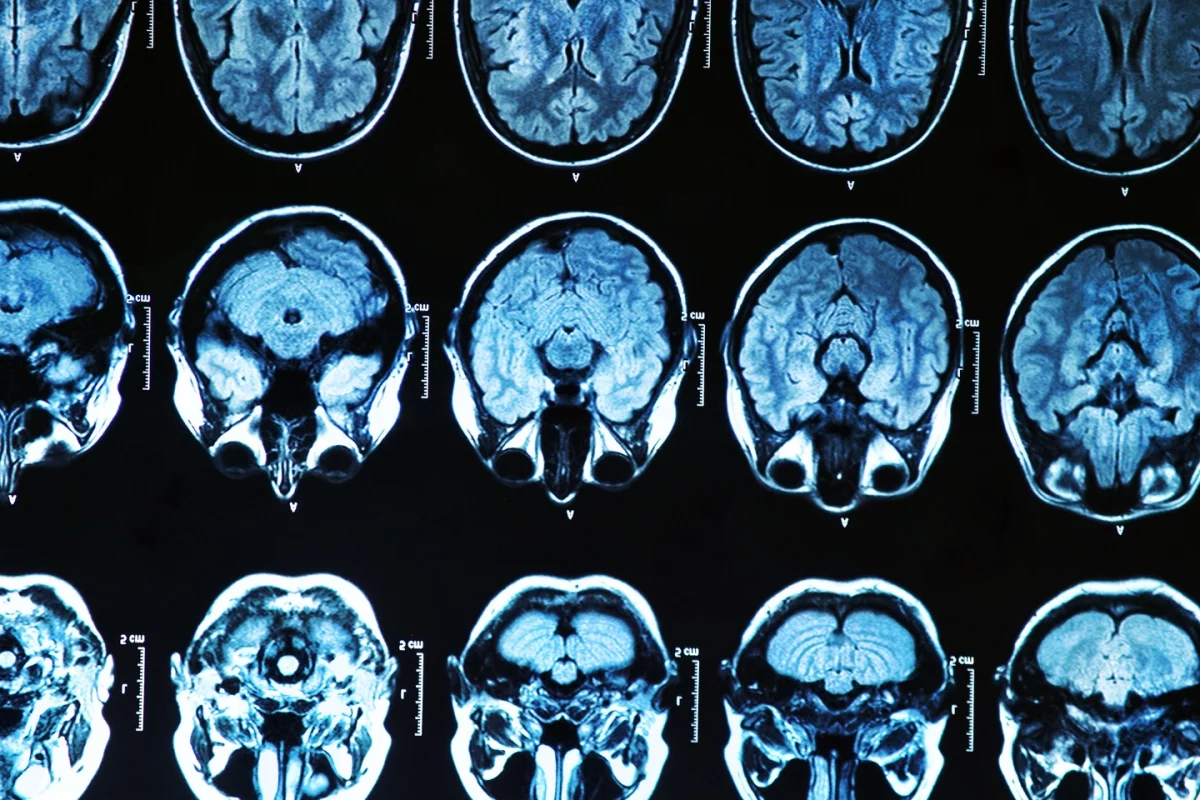 A ground-breaking new treatment that has proven safe in phase 1/2a human trials could potentially be adapted to treat a variety of other neurodegenerative diseases