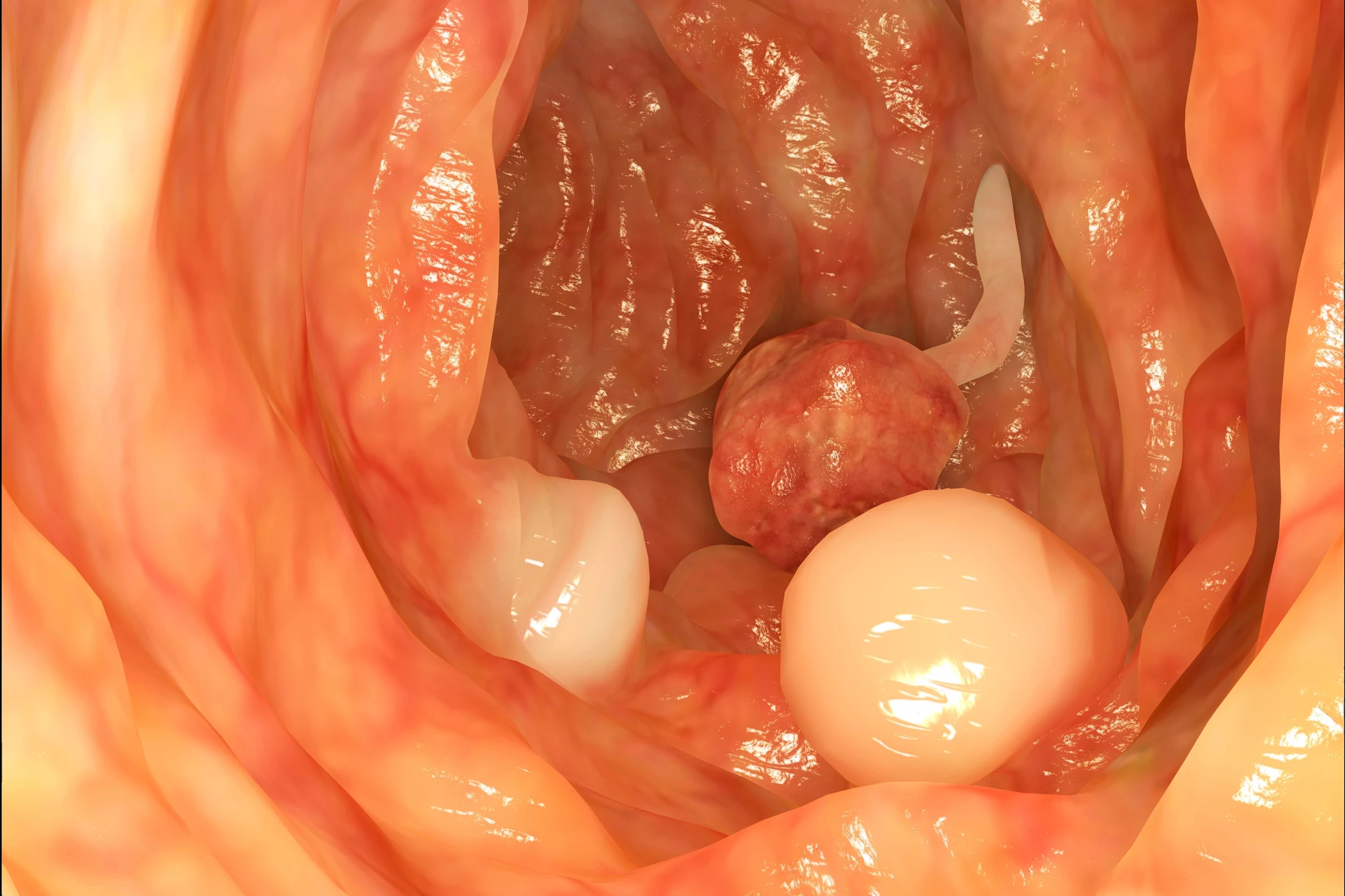 An increase in gut bacteria led to a decrease in the risk of developing polyps, the precursor to colon cancer