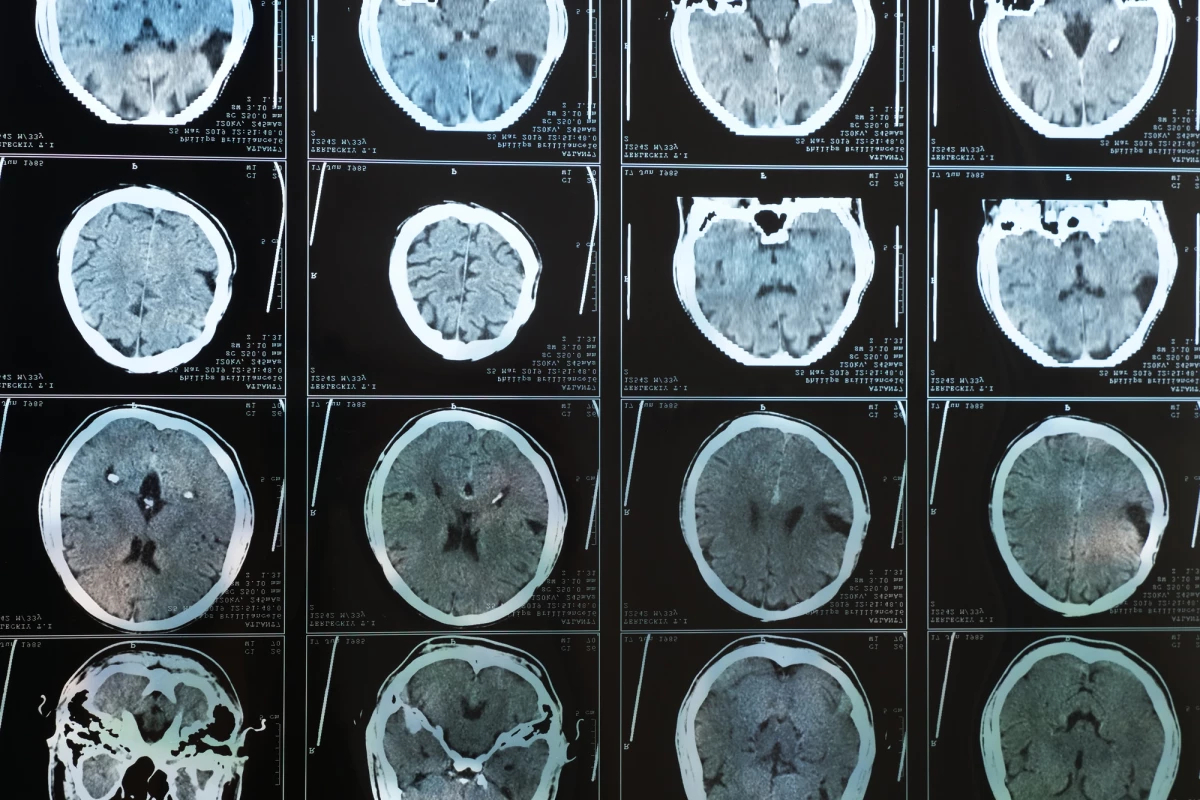 A direct association between increased body weight and reduced blood flow in the brain was detected in a new study