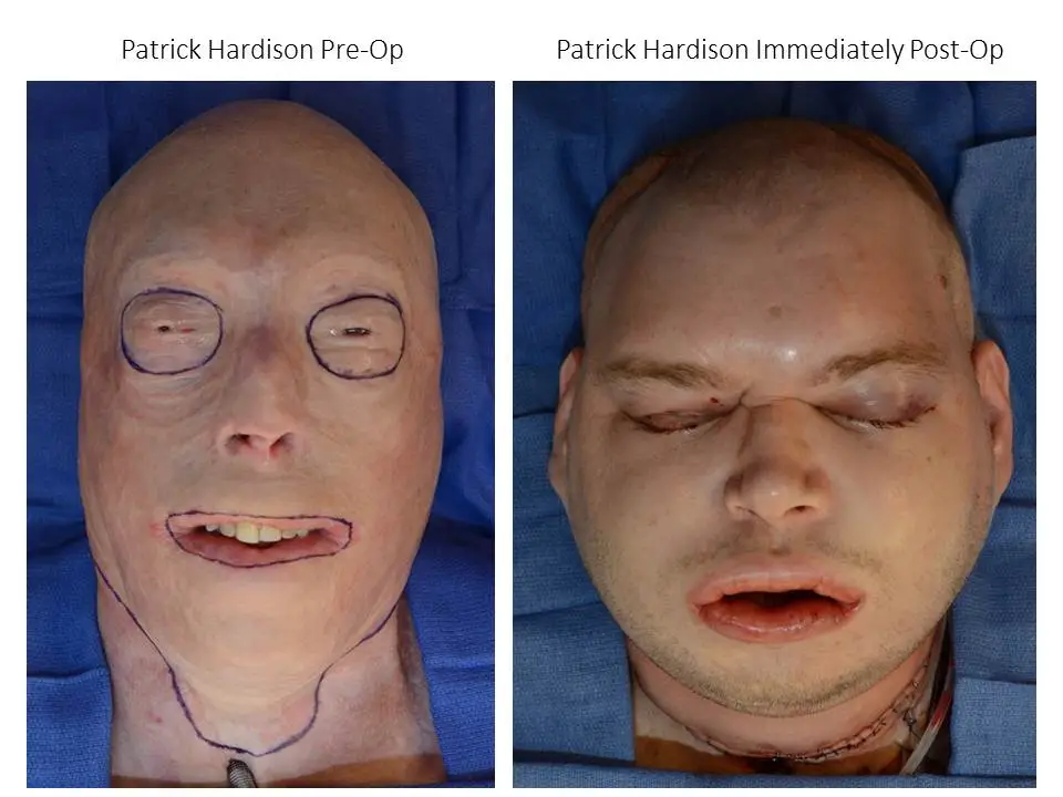 Hardison before and immediately after primary transplant surgery