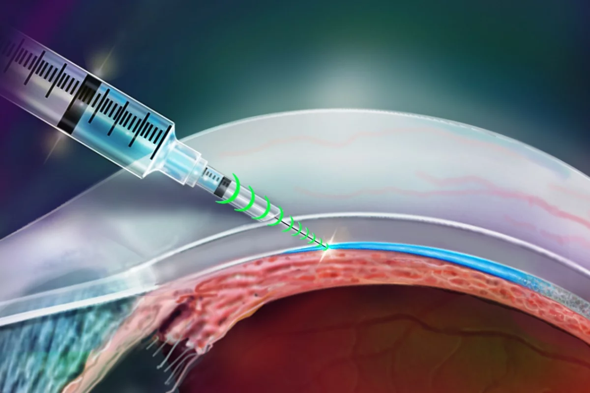 An illustration of the i2T2 needle being used to deliver medication to the eye's suprachoroidal space