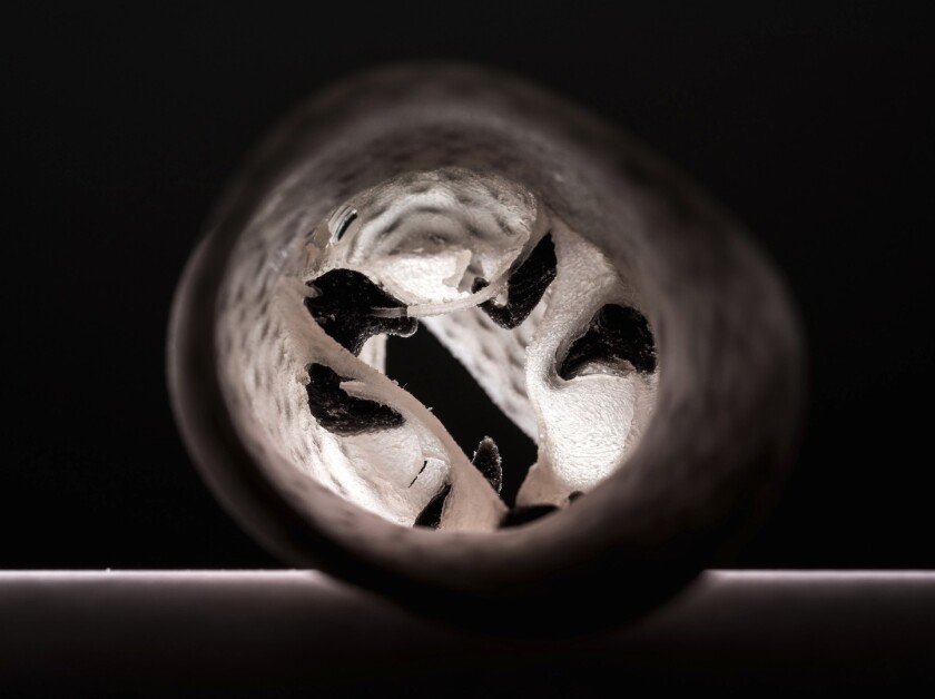 The 3D printed heart valves can be recreate in great detail what's happening inside a patient: the black areas represent calcium deposits in the valve