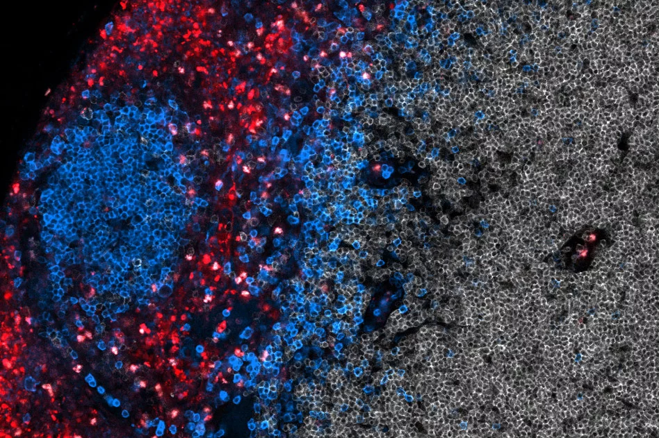 T cells (red) and B cells (blue) in the lymph nodes, after the vaccine CAR-T cell therapy kicks them into overdrive