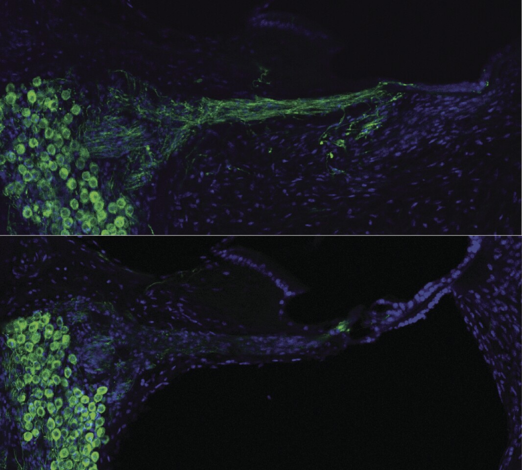 Regenerated auditory nerves using gene therapy (top), control (bottom). (Image: UNSW)