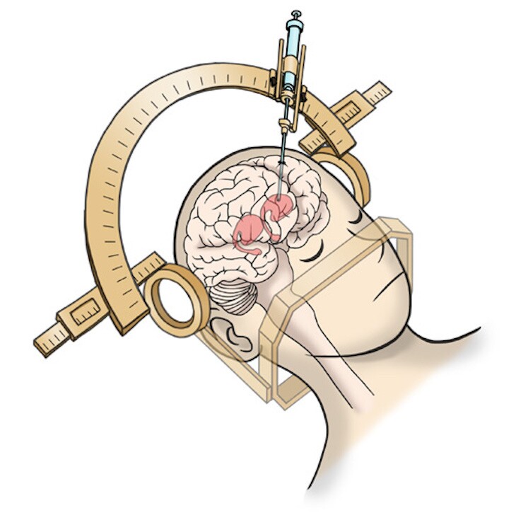 Parkinson's patients taking part in new trials will have a 12-mm (0.5-in) hole drilled through their skull and five million iPSC-derived dopaminergic progenitors transplanted into their brains with a specialized device