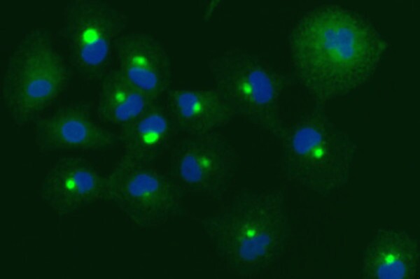 The fluorescent green spots are blobs of dysfunctional proteins building up on cancer cells, as a result of the new treatment