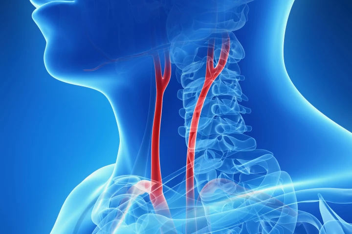 Blood vessels such as the carotid artery resonate in a distinct manner when excited by ultrasound pulses