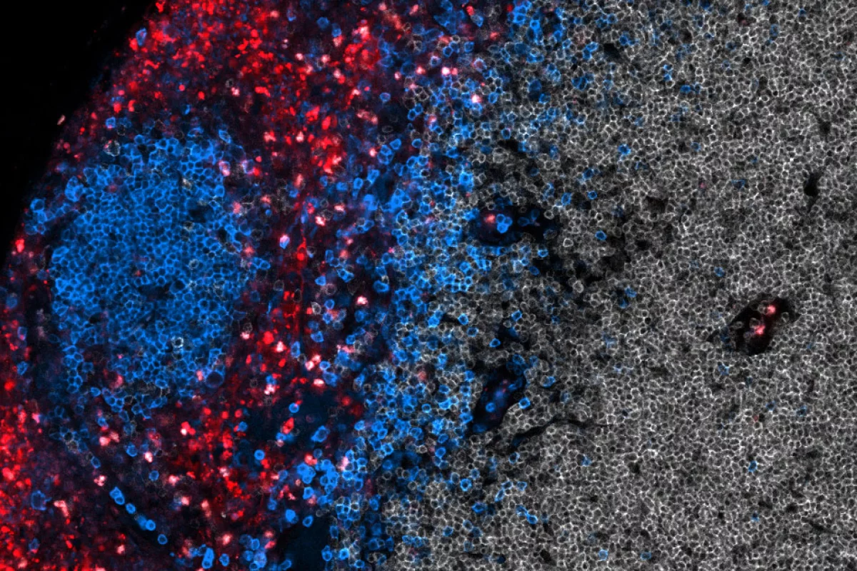 T cells (red) and B cells (blue) in the lymph nodes, after the vaccine CAR-T cell therapy kicks them into overdrive