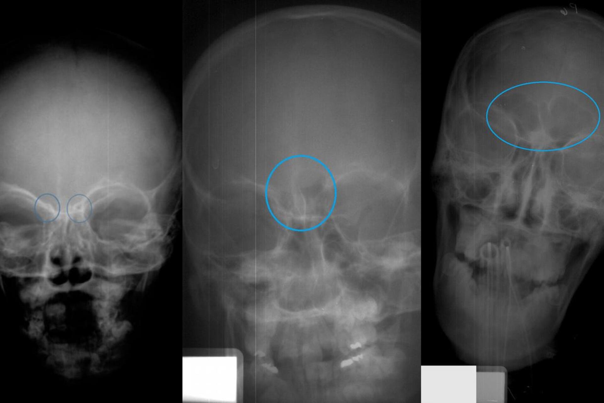 Sinus Xrays reveal age of children