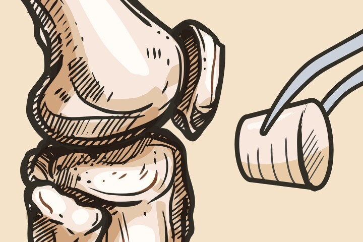 Synthetic 'plugs' heal damagedcartilage and bone and may replace total knee replacements