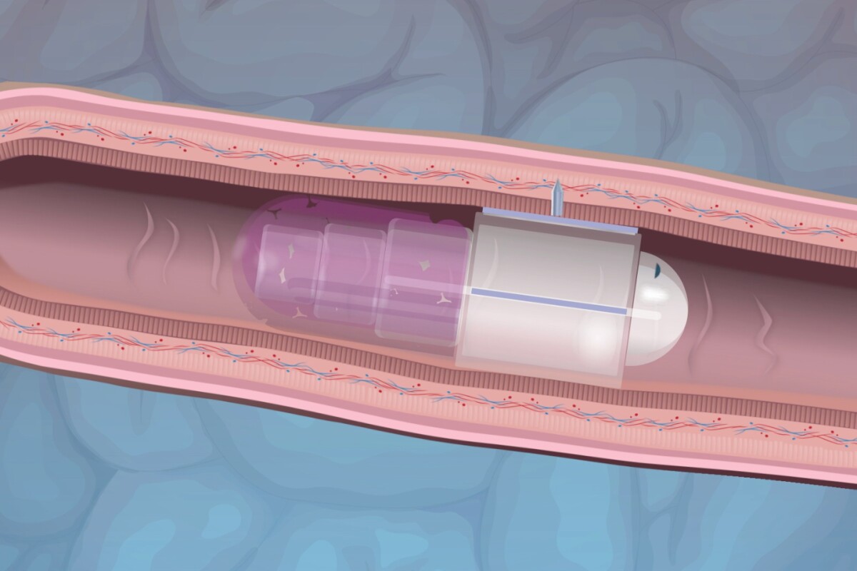 An x-ray view of the RaniPill deploying its microneedle