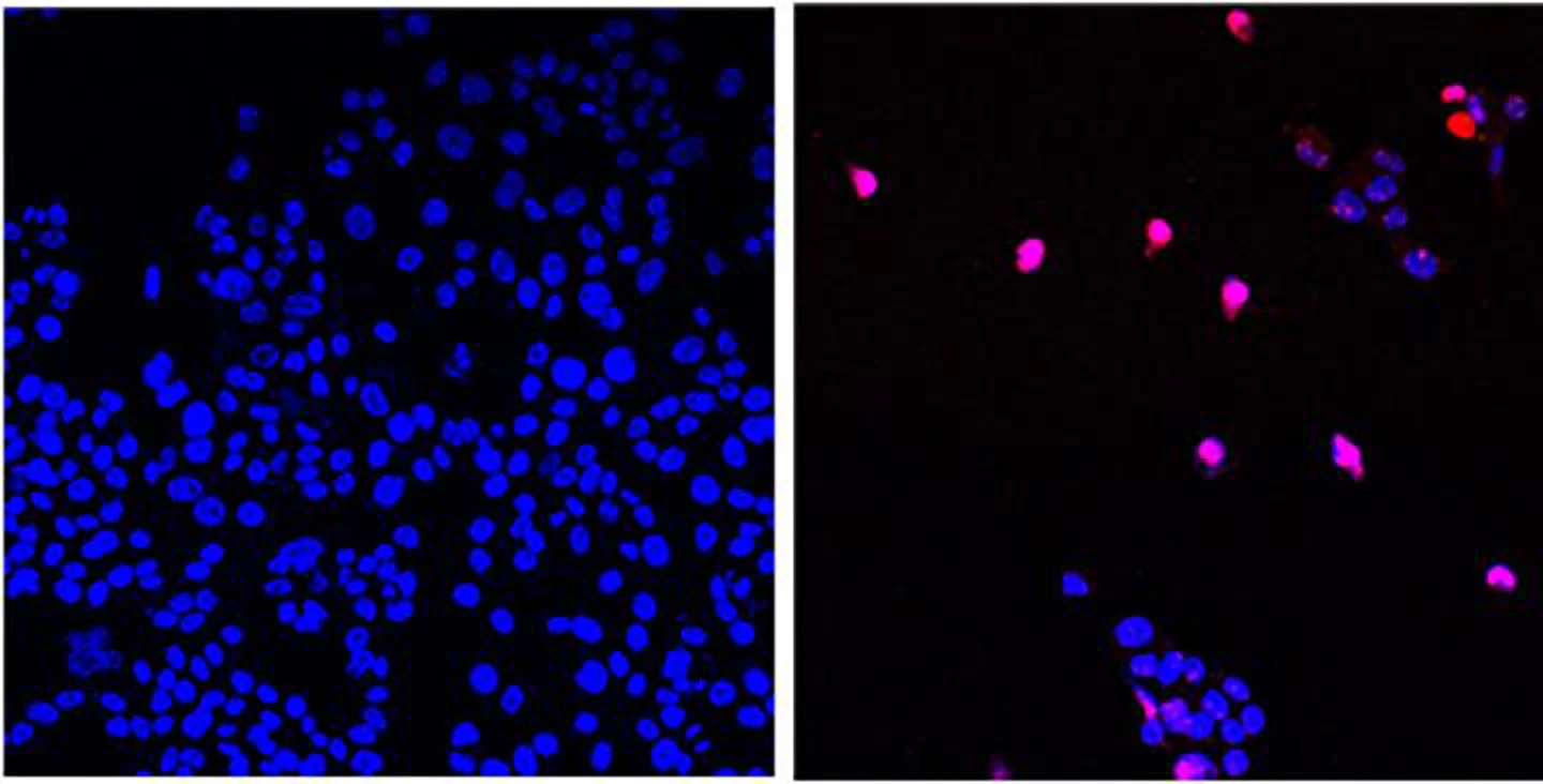 AOH1996 targets a cancerous variant of the protein PCNA. Here we see untreated cancer cells (left) and cancer cells treated with AOH1996 (right) undergoing cell death (violet)