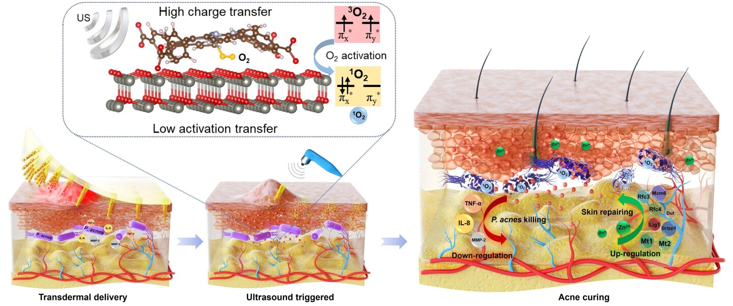 Microneedle patch teams up with ultrasound to kill acne bacteria
