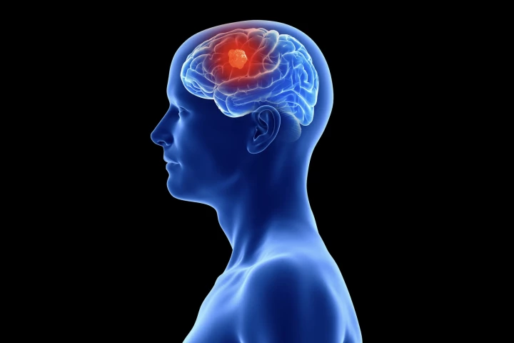 Scientists discover the unique way glioblastoma erodes bone