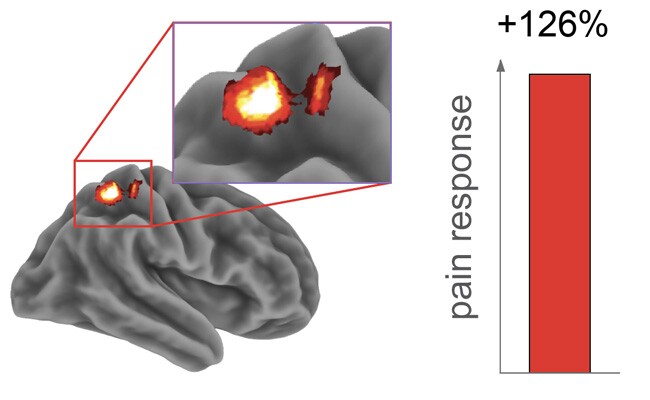 Activity in the brain’s somatosensory cortex, which receives pain signals, increased 126 percent following a sleepless night vs. a full night of sleep