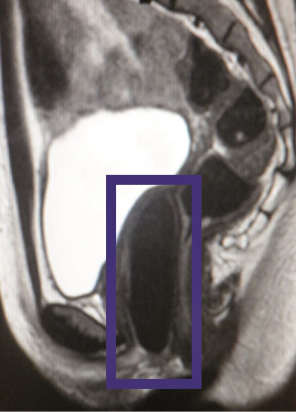 An MRI showing one of the lab-engineered vaginas in place