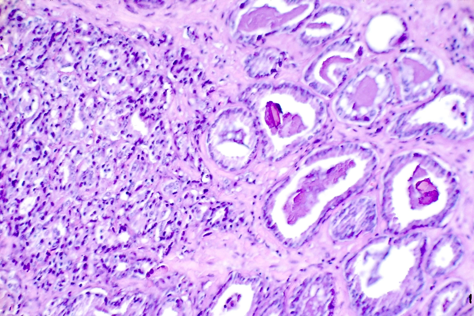 A microscope image of prostate cancer cells