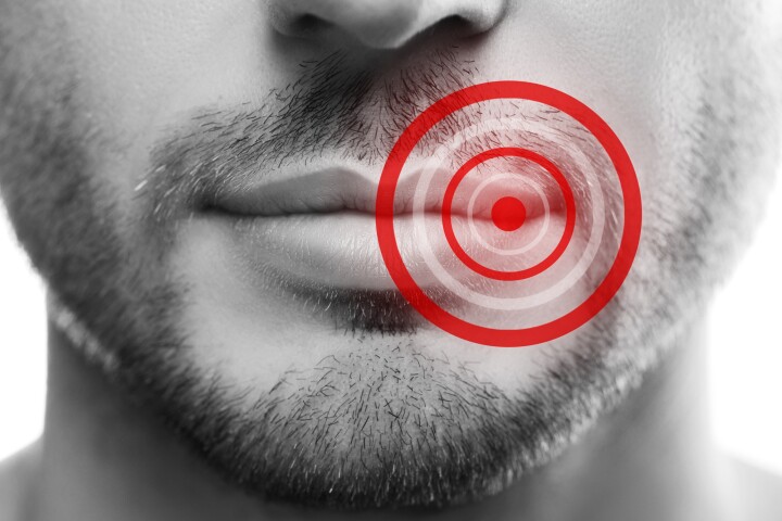 Scientists have traced the origin of the "cold sore" virus back thousands of years