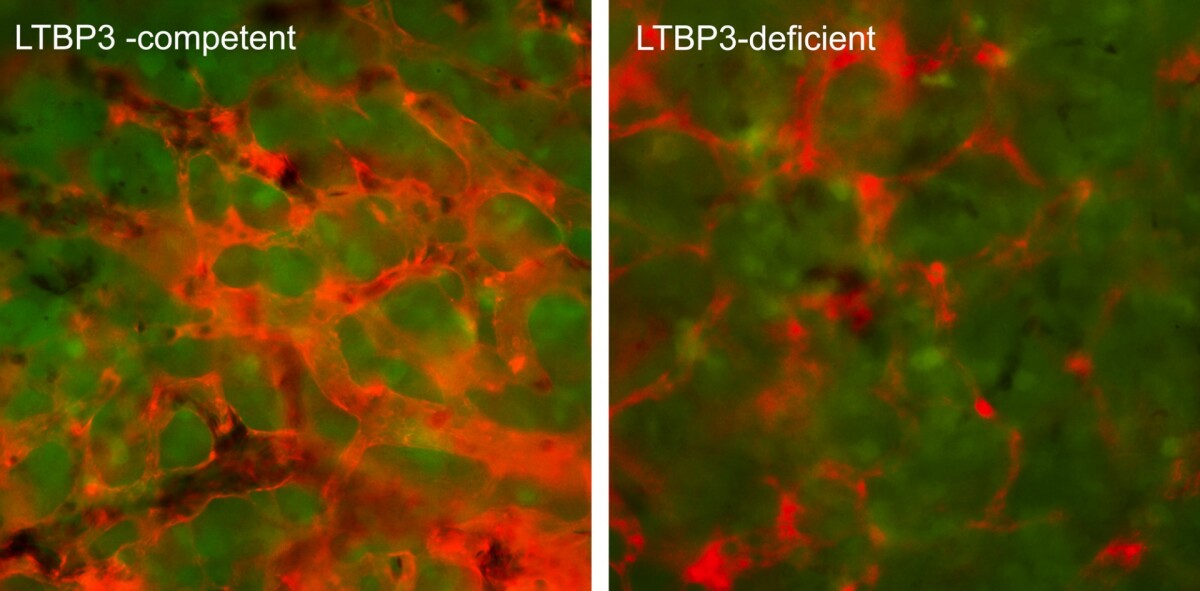 New blood vessels (red) in cancer cells (green): the left image shows healthy vessels in a regular tumor, while the right image shows thinner, collapsed vessels in a tumor that's had its LTBP3 supressed
