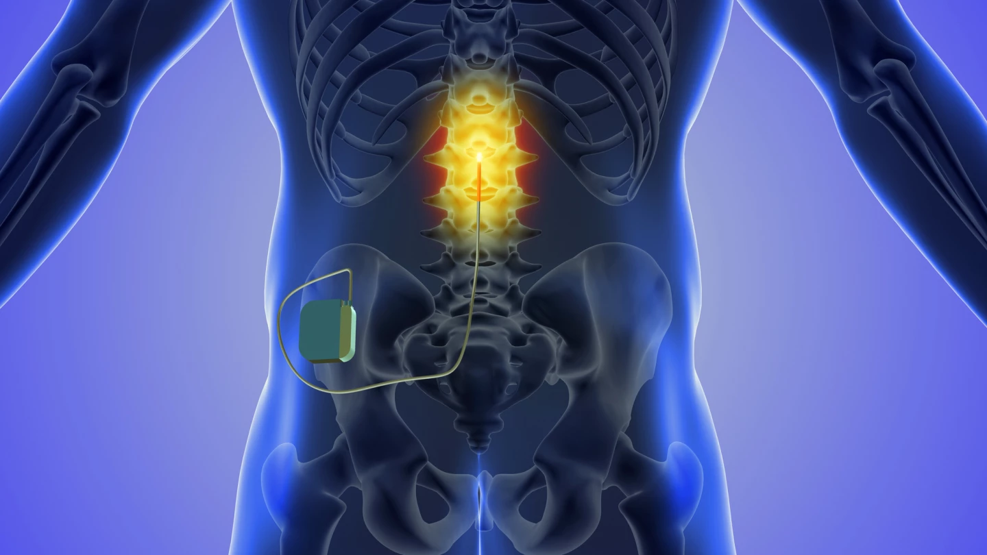 Concept of spinal cord stimulation