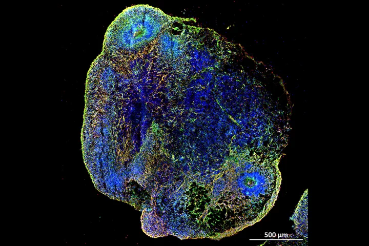 Researchers have used lab-grown brain organoids, such as the one pictured here, to identify drugs to reverse premature brain aging caused by COVID-19 infection