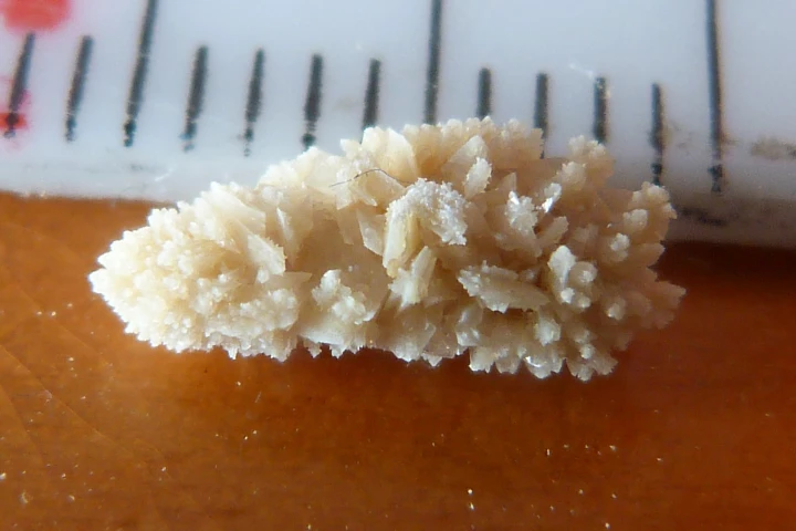 A particularly nasty-looking kidney stone – imagine trying to pass this thing as you pee