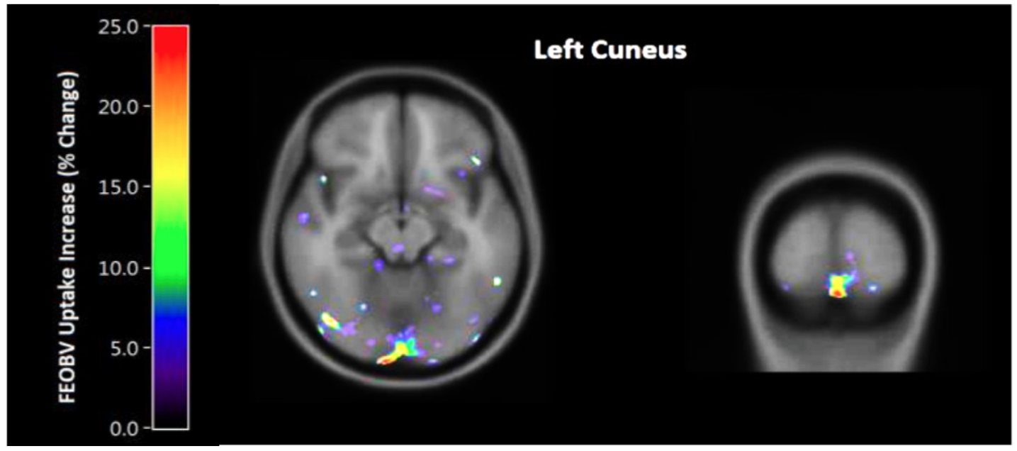Post six weeks of brain training, increases in acetylcholine were seen in the brain. This image is of the left lingual gyrus/cuneus