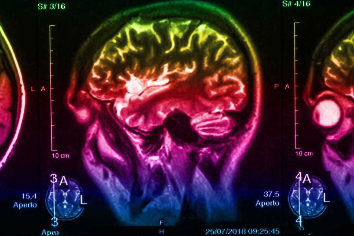 New Brain Imaging Study Reveals Signs Of Parkinson S Decades