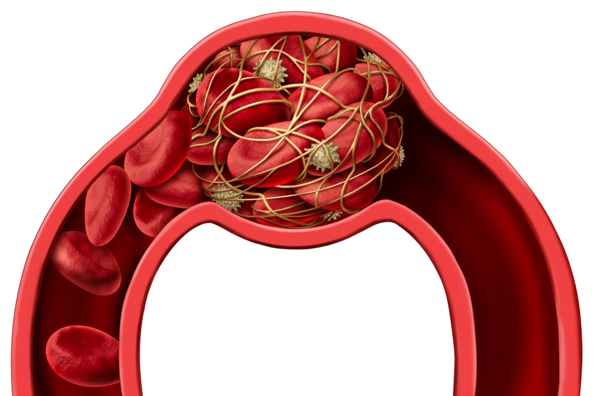 A new drug could help reduce neuron damage in the brain after a stroke