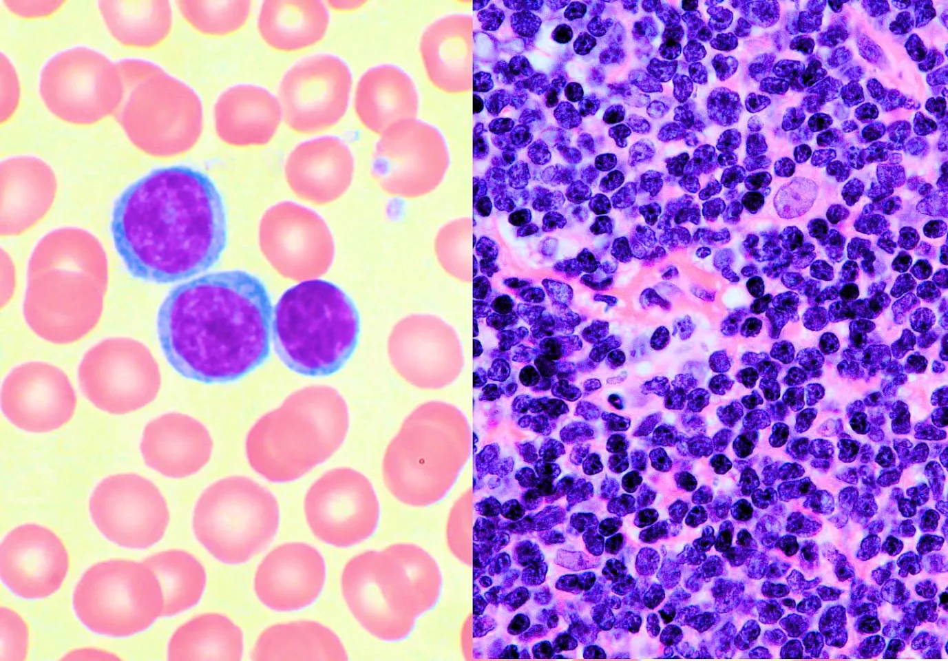 A pair of high power micrographs of blood cancers (left) chronic lymphocytic leukemia - dark nuclei with little cytoplasm (right) mantle cell tumor - lymphoma cells have irregular boundaries (Photos: Mary Ann Thompson and Gabriel Caponetti, MD, both via Wikimedia Commons)