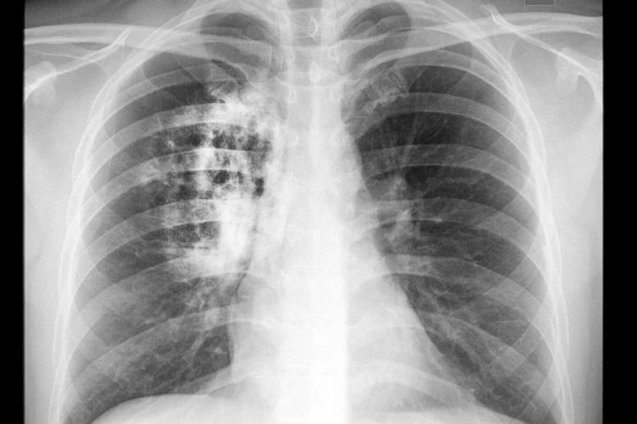 Findings that a variant of the CIZ1 protein is present in lung cancers could lead to the development of a blood test for the disease (Image: Shutterstock)