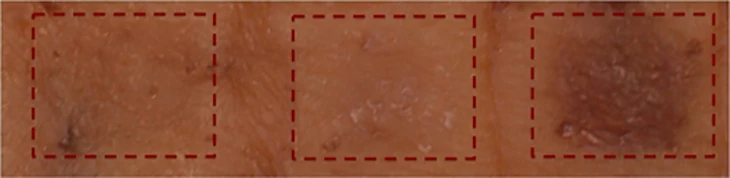 Cultured human skin treated for eight days with the drug, seen on the right, showed significant darkening compared to control substances