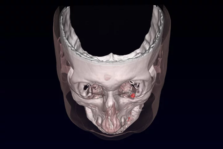 The magnetic prosthesis (shown in red) are implanted to reduce uncontrollable eye movements associated with the condition nystagmus
