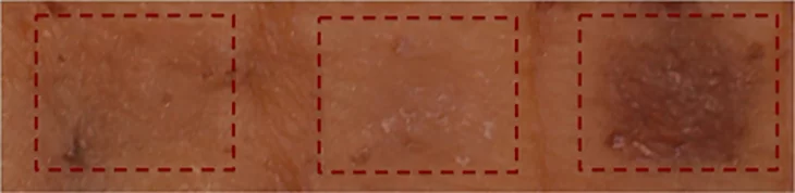 Cultured human skin treated for eight days with the drug, seen on the right, showed significant darkening compared to control substances