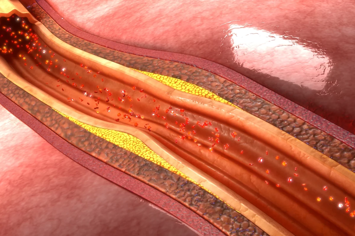 Researchers have developed nanoparticles that can reveal the presence of atherosclerotic plaques before they trigger heart attacks or strokes