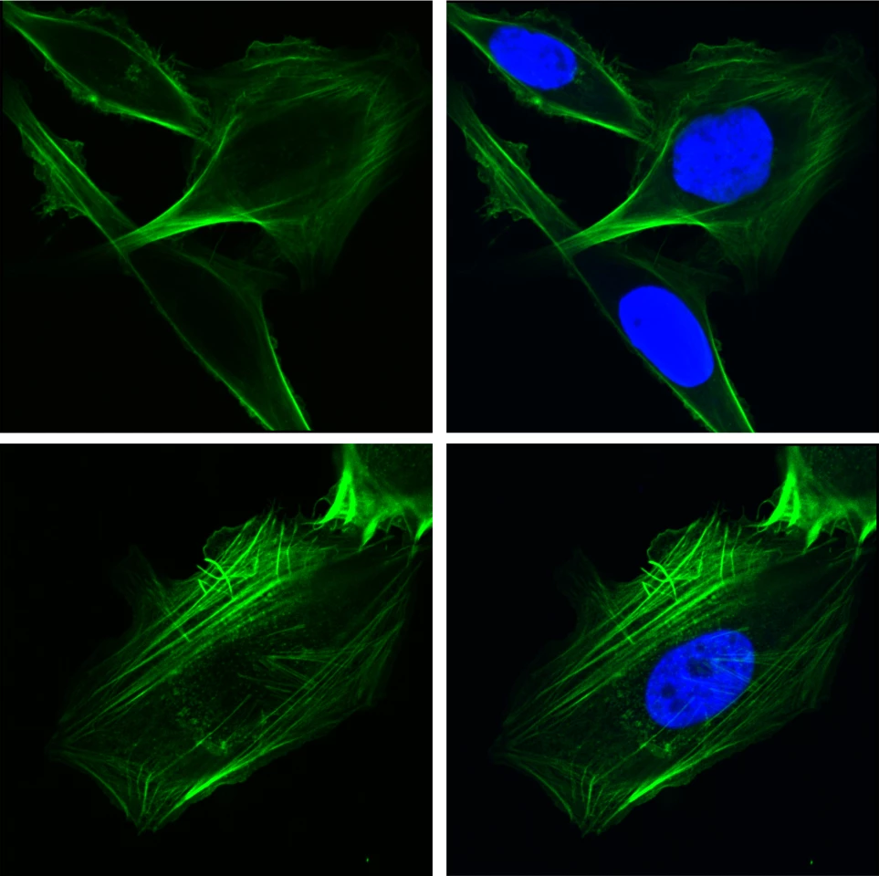 Human lung cancer cells engineered to over-express GRP78 in the nucleus (TOP). Cells lacking GRP78 in the nucleus (BOTTOM). The green staining depicts the cytoskeletal protein F-actin, which controls cell shape and motility and the blue staining depicts the nucleus.