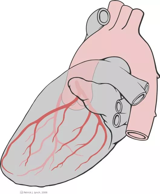 A technique that combines nanotechnology with adult stem cells appears to destroy atherosclerotic plaque and rejuvenate arteries (Image: Patrick J. Lynch, medical illustrator)