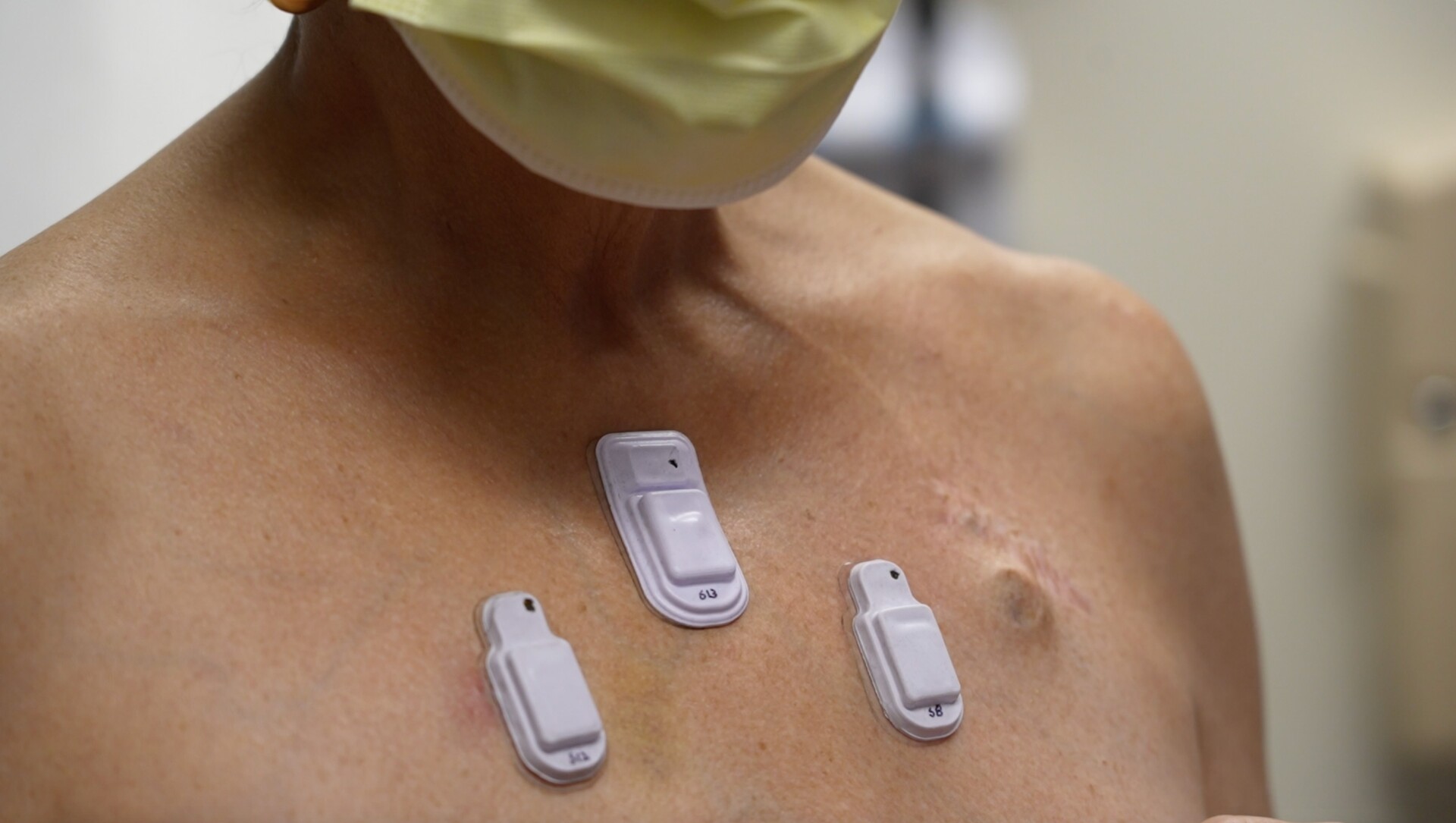 Wearable stethoscope can continuously monitor patients in real time