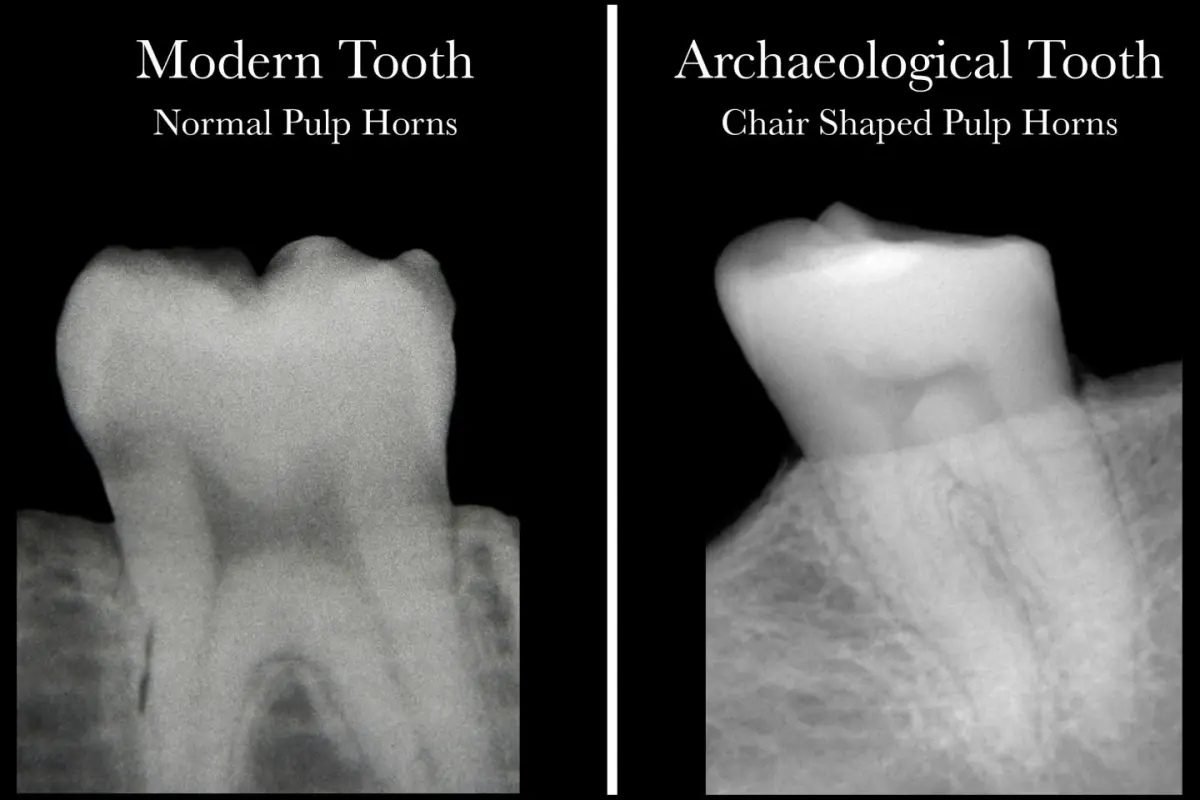 A modern healthy tooth with pulp "horns" (left), and an archeological tooth indicating a lack of vitamin D