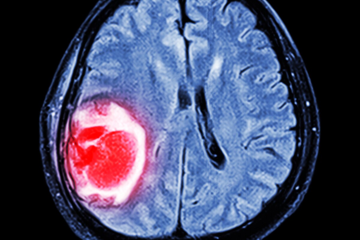 MRI of a brain scan revealing a tumor growth. In future, an adaptation of this imaging technology could also reveal the stiffness of these growths