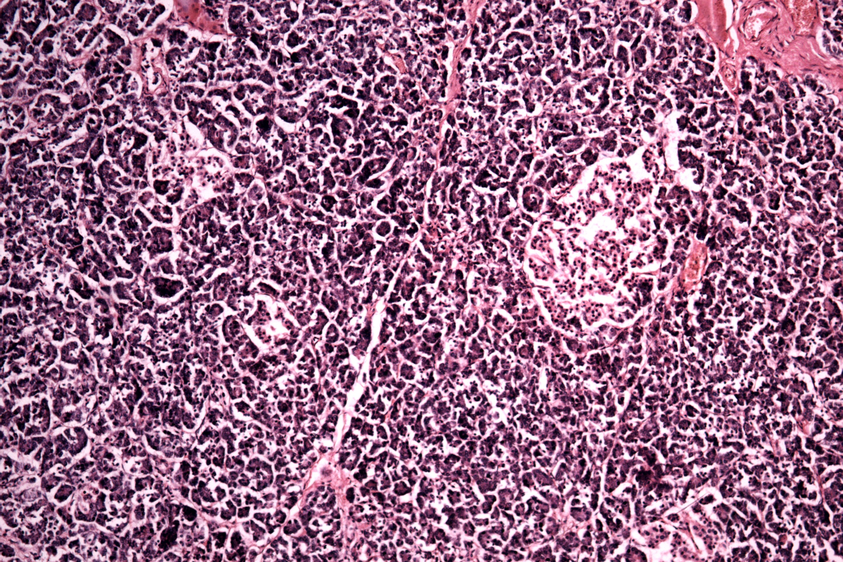 Pancreatic Cells Are Revived to Make Insulin by a Cancer Medication ?url=http%3A%2F%2Fnewatlas Brightspot.s3.amazonaws.com%2F18%2F08%2Fb5d0ab564b118f7811a8b740016e%2Fdepositphotos 22004173 L