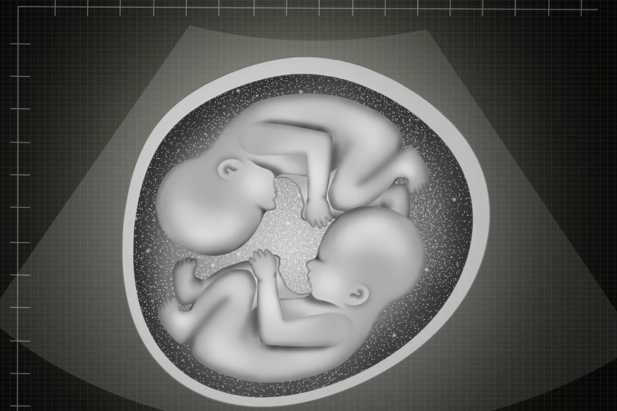 Semi-identical twins born in Australia mark only the second known case in the world