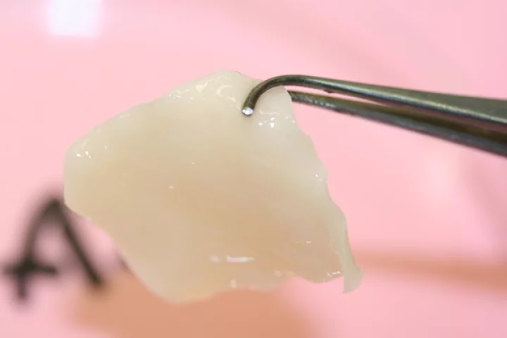 The engineered cartilage was grown from the patient's own cells and could provide a less-invasive from of reconstructive surgery