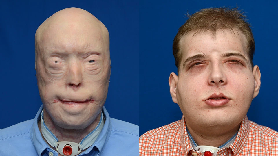 Surgeons at New York University's (NYU) Langone Medical Center have replaced the entire face of a patient in the what is claimed to be the most extensive face transplant ever carried out